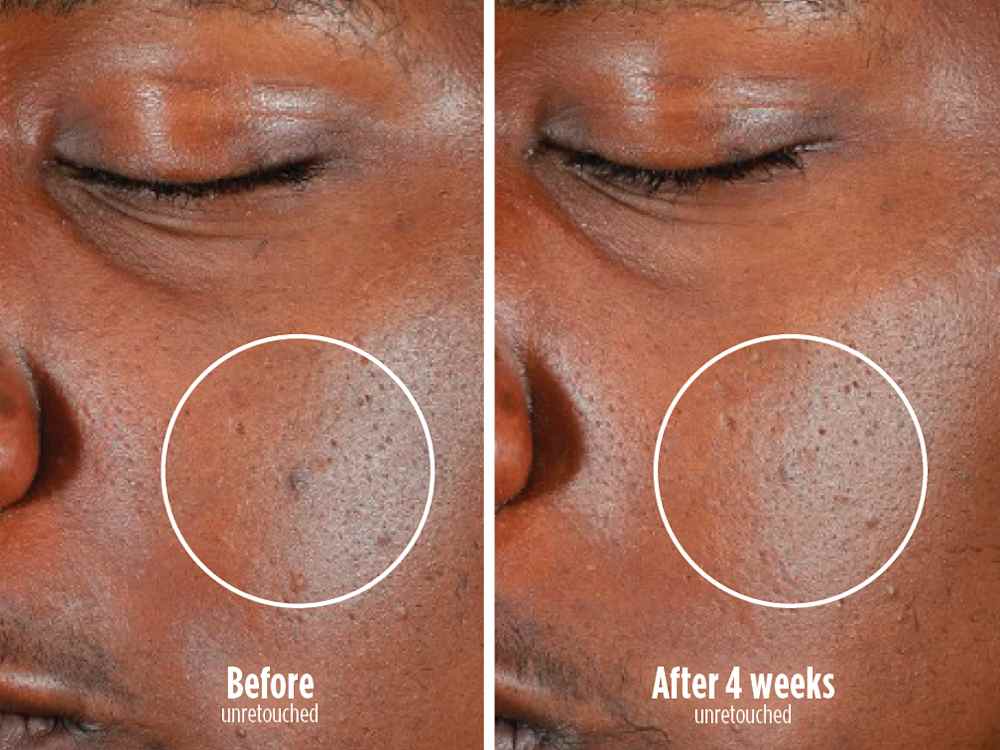 Photo montrant un avant/apr&egrave;s des imperfections apr&egrave;s utilisation du masque CryoGlow.