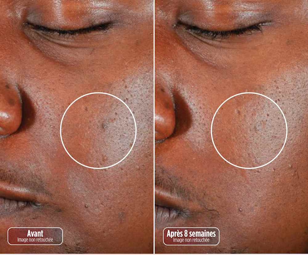 Photo montrant un avant/apr&egrave;s des imperfections apr&egrave;s utilisation du masque CryoGlow.