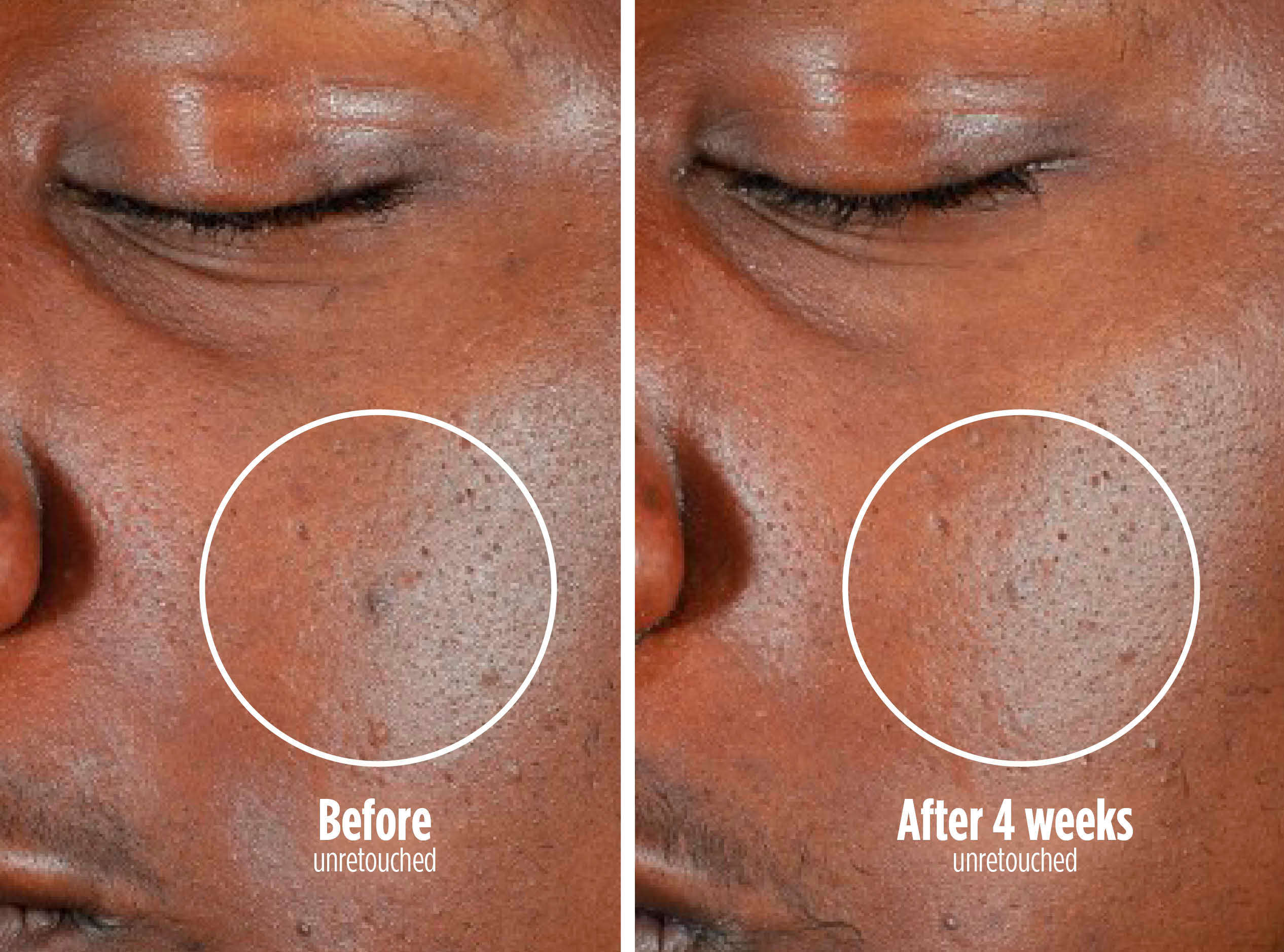 Reduce acne in 4 weeks