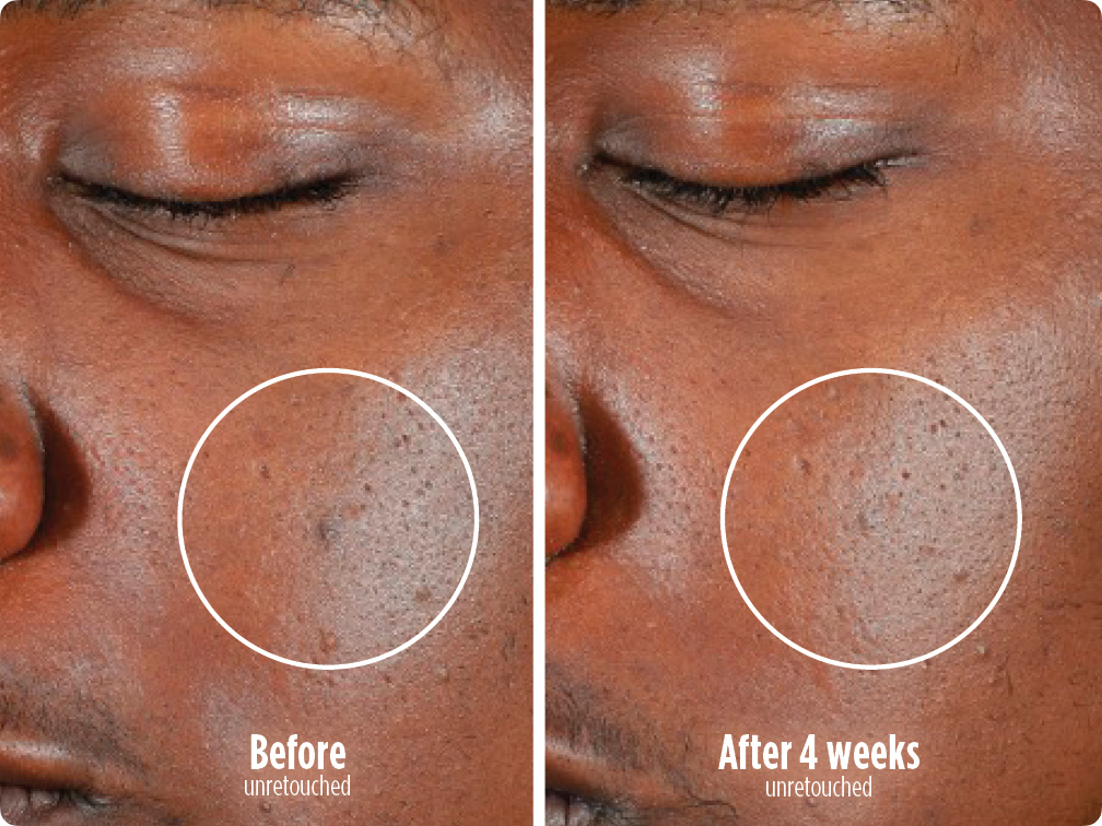 Clearer skin in 4 weeks.