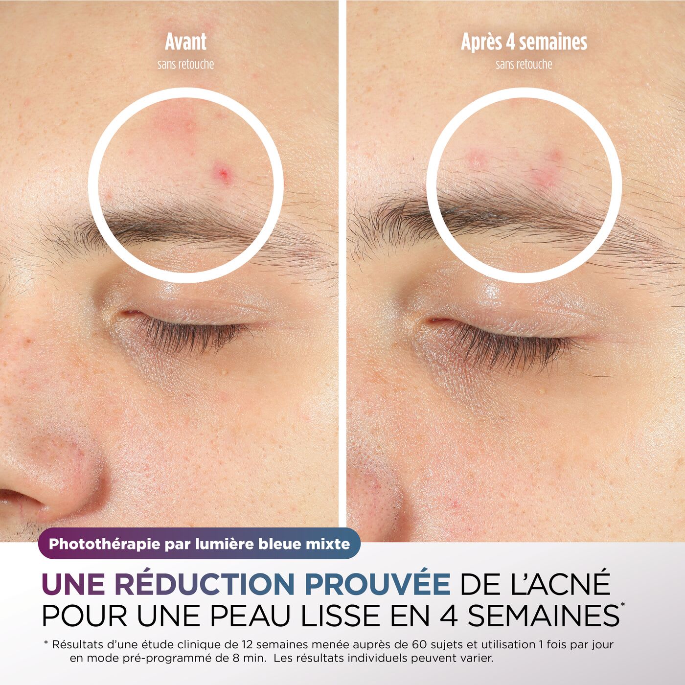 Image de Photothérapie par lumière bleue mixte 