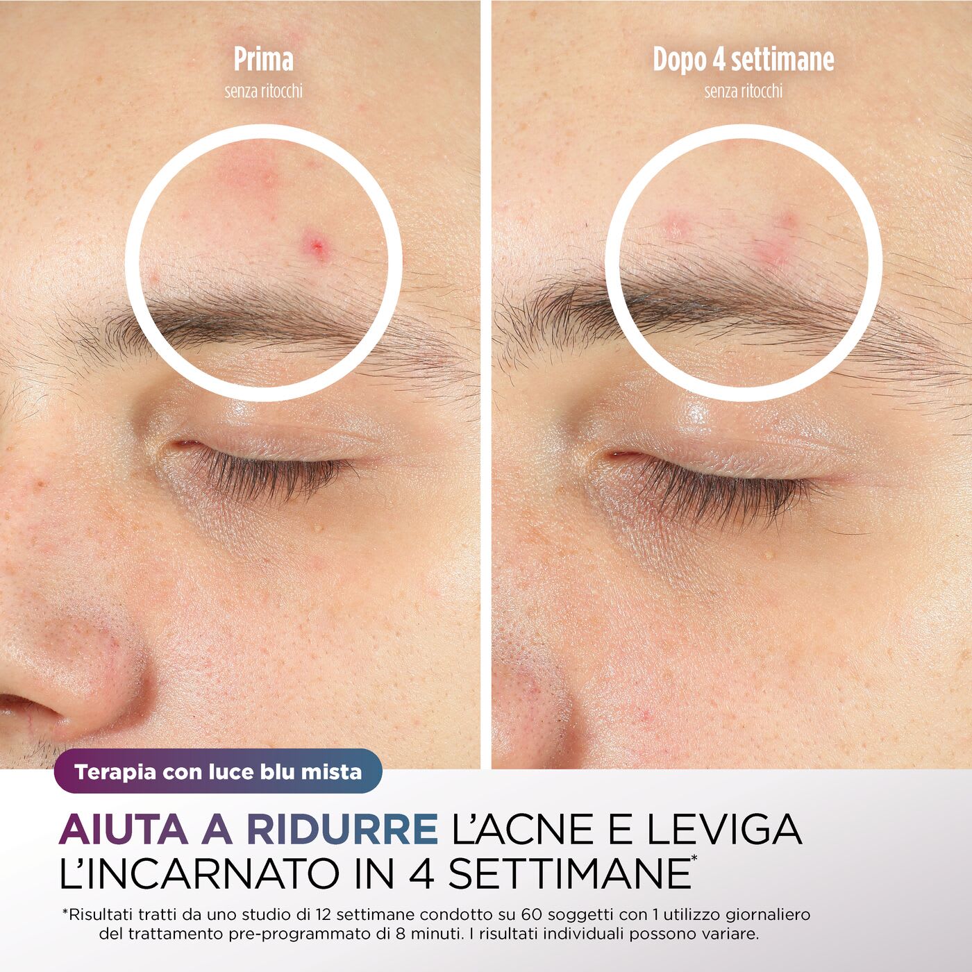 Immagine della Terapia con luce blu mista